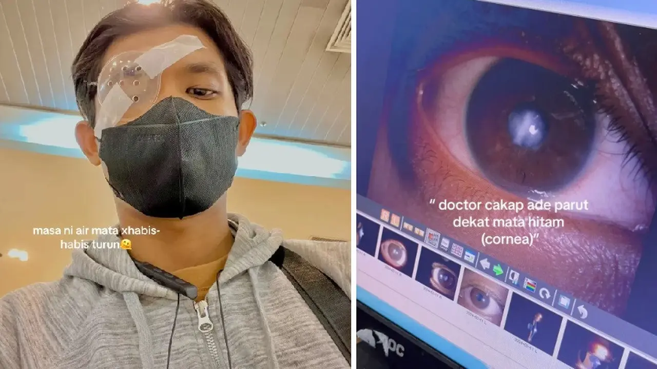 Kisah Pemuda 21 Tahun Transplantasi Kornea Mata Karena Sering Kucek Mata