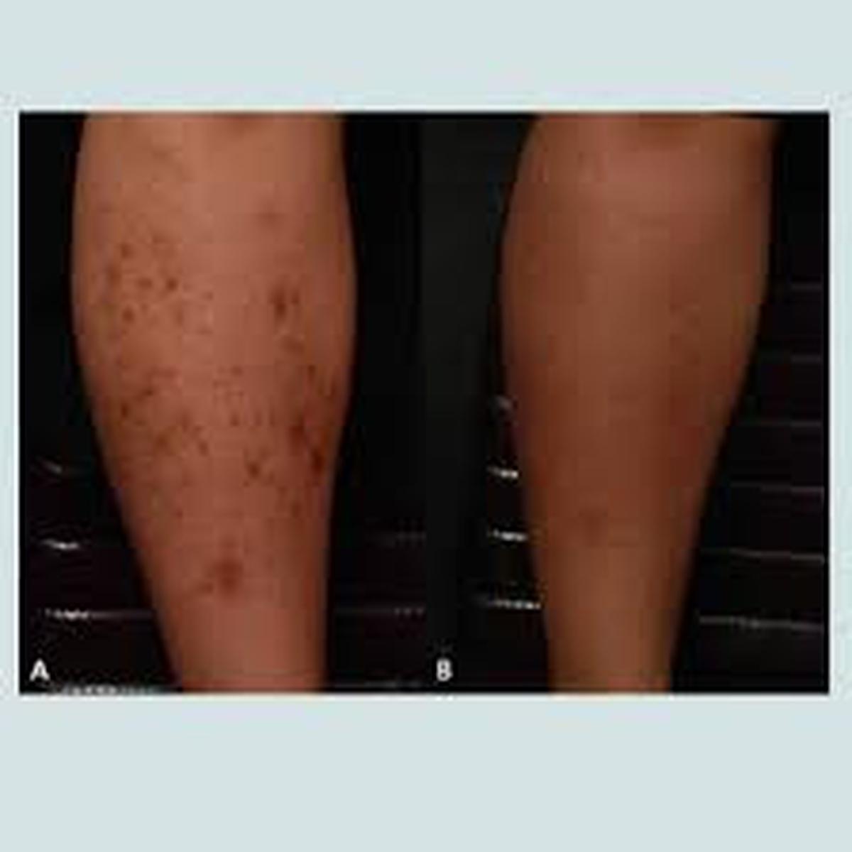hiperpigmentasi pada kaki