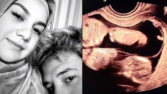 Fakta Twin to Twin Transfusion Syndrom, Penyebab Meninggalnya Bayi Kembar Irish Bella