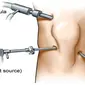 Operasi artroskopi pada cedera lutut ACL dibutuhkan tiga titik sayatan untuk melakukan rekonstruksi pada bagian yang akan diperbaiki. (Foto: www.thaimakeover.com)