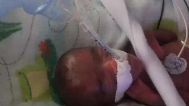 Bayi Saybie yang merupakan bayi terkecil di dunia (AFP Photo)
