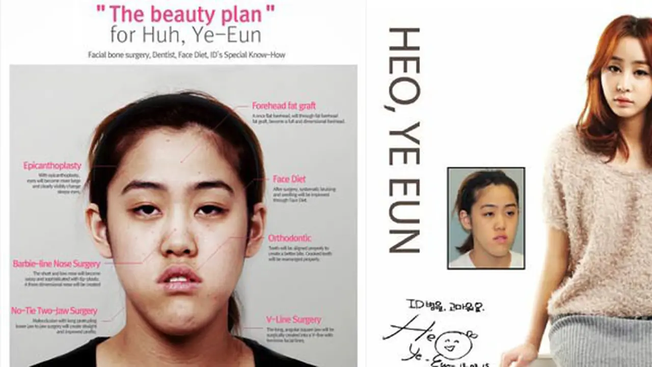 Heo Ye-Eun before and after | Foto: copyright idhospital.blogspot.com