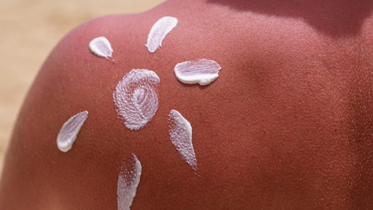 Ilustrasi Kulit Terbakar Matahari atau Sunburn (©Freepik)