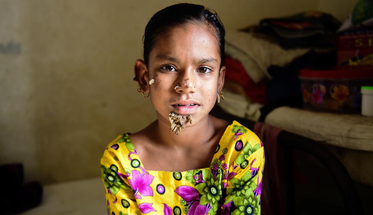 Sahana Khatun yang wajahnya ditumbuhi beberapa kutil menjalani perawatan di sebuah rumah sakit di Dhaka, Bangladesh, 30 Januari 2017. Mereka yang menderita penyakit tergolong langka di dunia ini disebut tengah menderita penyakit ganas. (STR/AFP)