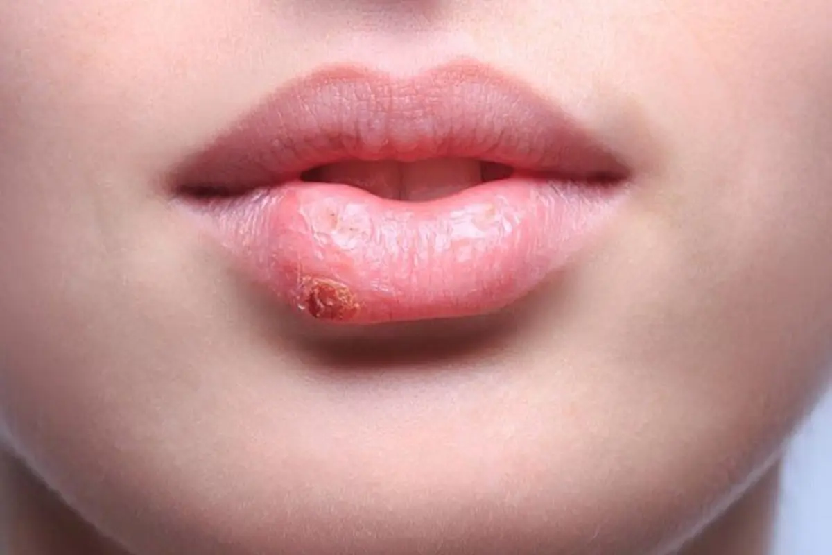 herpes
