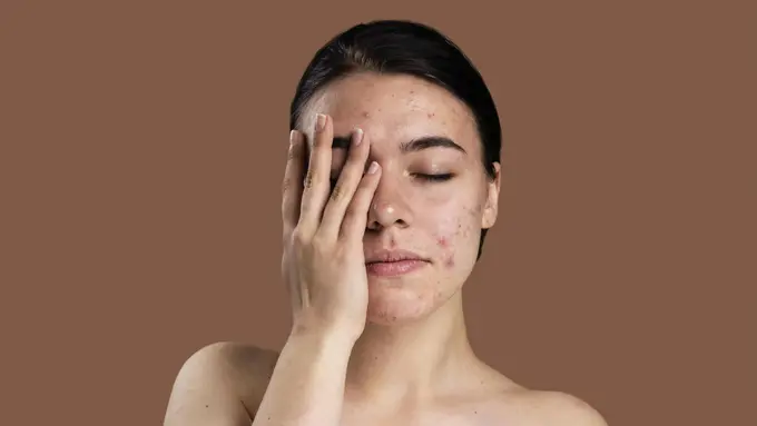 Membantu Mengatasi Jerawat dan Kulit Berminyak [Dok/freepik.com]