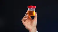 Ciri-Ciri Penyakit Asam Urat yang Terlihat pada Urine, Lakukan Deteksi Dini Sebelum Terlambat