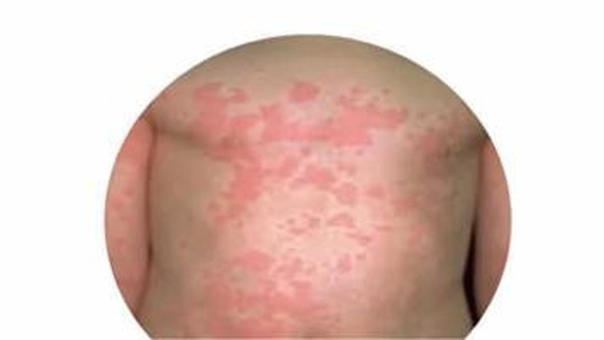 Gejala Campak Bukan Sekadar Ruam, Kenali 3 Fasenya