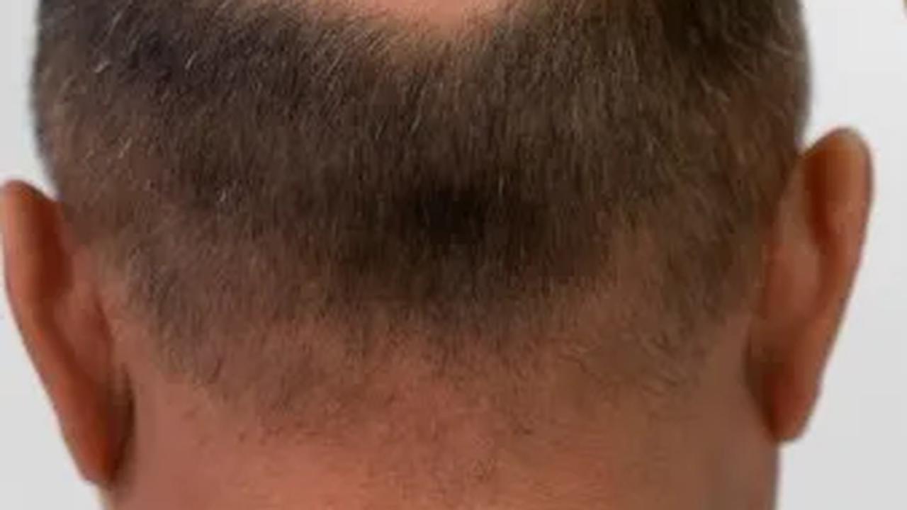 Terapi kanker seperti kemoterapi juga berpotensi menyebabkan kerontokan rambut yang signifikan.