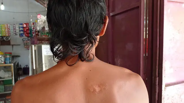 Bekas luka tembak di punggung Mulyanto pada peristiwa di Desa Setrojenar, Kecamatan Buluspesantren, Kebumen, Rabu (24/3/2021). (Liputan6.com/Rudal Afgani Dirgantara)