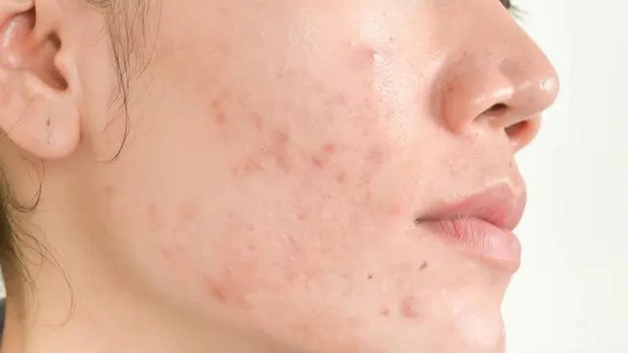 Perawatan Alami untuk Jerawat, Cara Efektif dengan Menggunakan Masker Oatmeal dan Madu