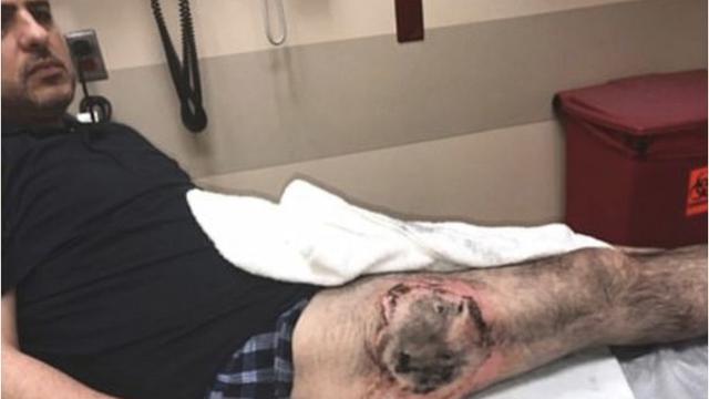 Baterai Vape Meledak di Kantong Celana, Paha Tukang Daging Alami Luka Bakar Tingkat Tiga