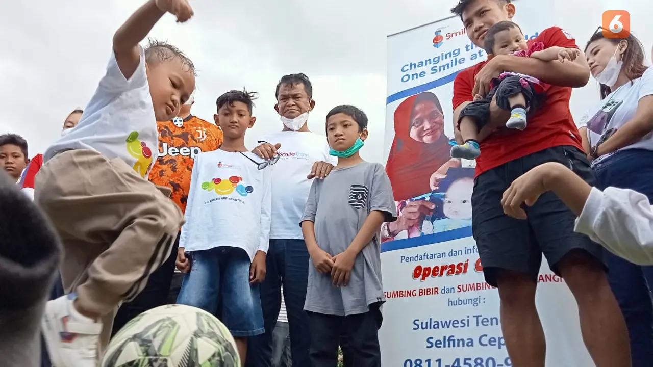 witan sulaeman bersama anak-anak bibir sumbing