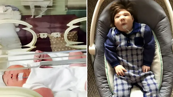 Harapan Hidup 3 Persen, Bayi Ini Berhasil Lalui Tahun Pertamanya 