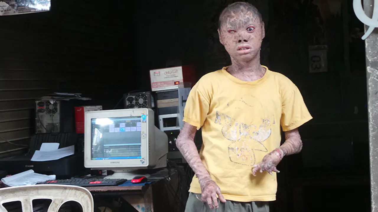 Ari Wibowo, Remaja Berkulit Ular