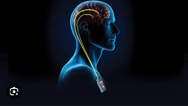 Deep Brain Stimulation, Operasi untuk Atasi Masalah Otak Termasuk Parkinson. Foto: Siloam Hospitals.