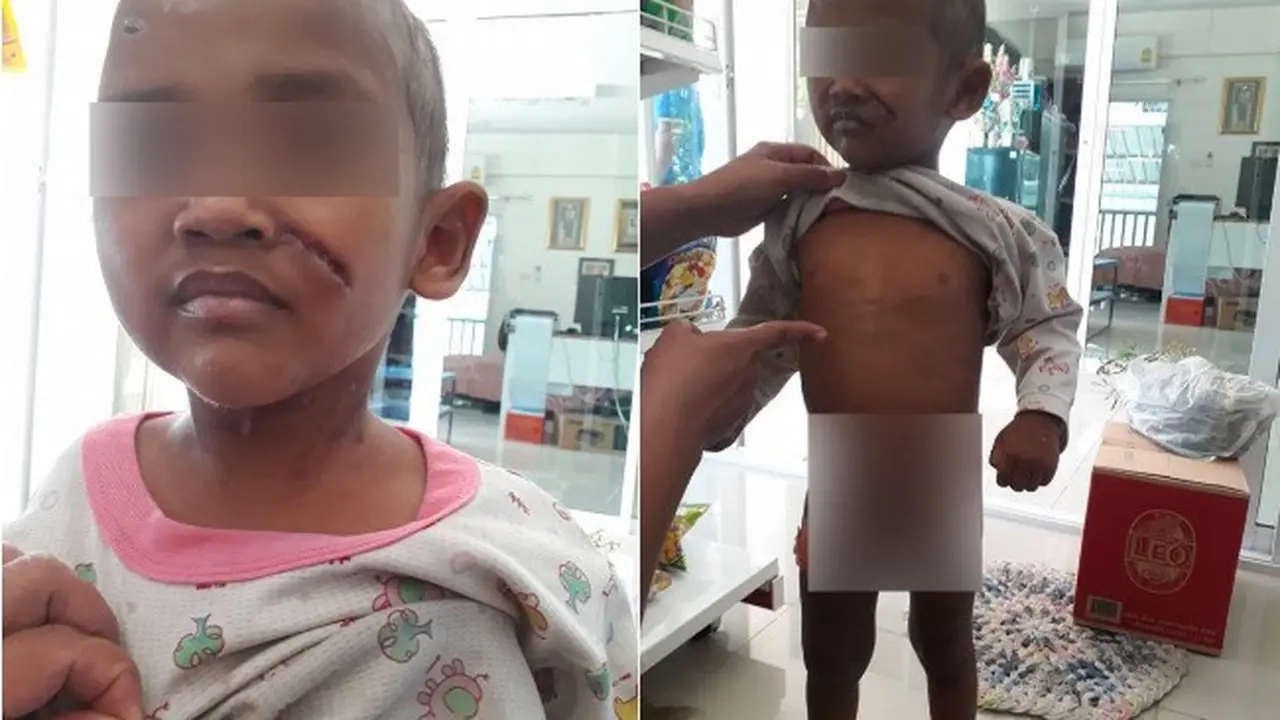 Disiksa Ortunya, Anak 3 Tahun Selamat karena Media Sosial