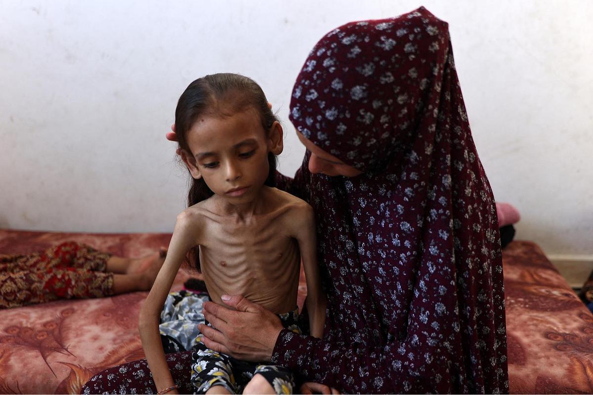 FOTO: Potret Pedih Mariam Anak 9 Tahun, Korban Kelaparan Gaza