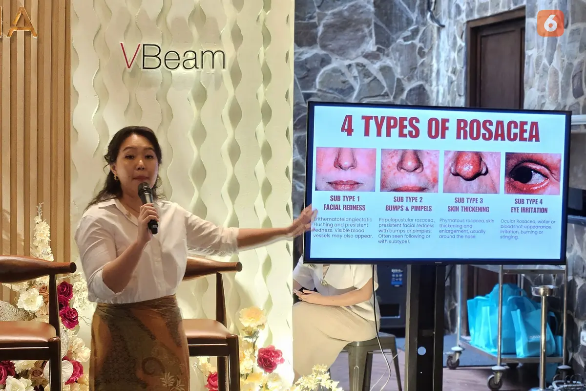Simak penjelasan lengkap dari dr. Nani Kumala Dewi, Sp.DVE, tentang perawatan yang tepat untuk rosacea, penyakit kulit yang sering disalahartikan sebagai jerawat (Foto: Aditya Eka Prawira/Liputan6.com)