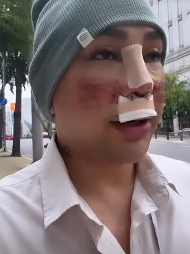 Potret Caren Delano Jalan-Jalan di Korea Usai Oplas, Wajah Masih Diperban