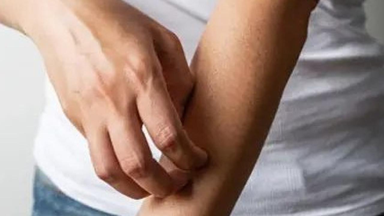 Kenali Penyebab Terjadinya Biduran dan Cara Tepat Mengatasinya