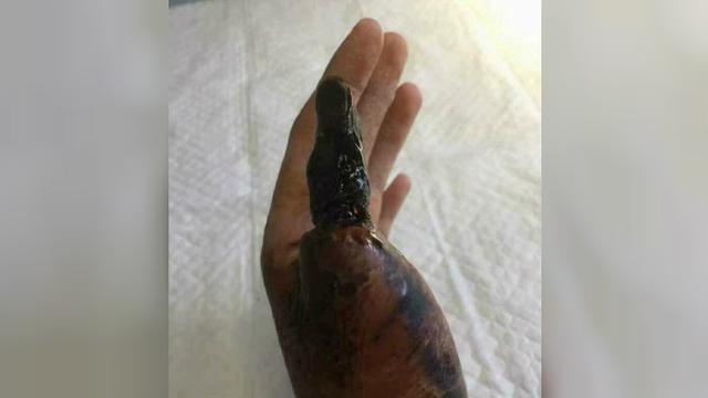 Bentuk jari korban setelah digigit ular (Facebook/Fakultas Kedokteran Hewan New York)