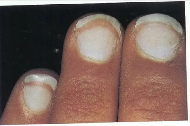 Tipe Leukonychia totalis. Source: dermatologyoasis.net