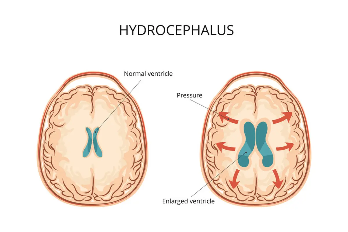 Hidrosefalus - KlikDokter.com (Logika600/Shutterstock)