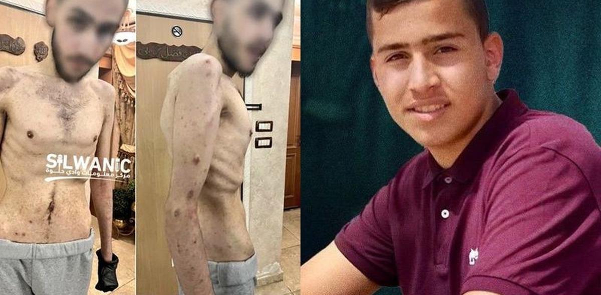 Kondisi Miris Tawanan Palestina yang Dibebaskan Israel 'Tinggal' Tulang & Penuh Kudis