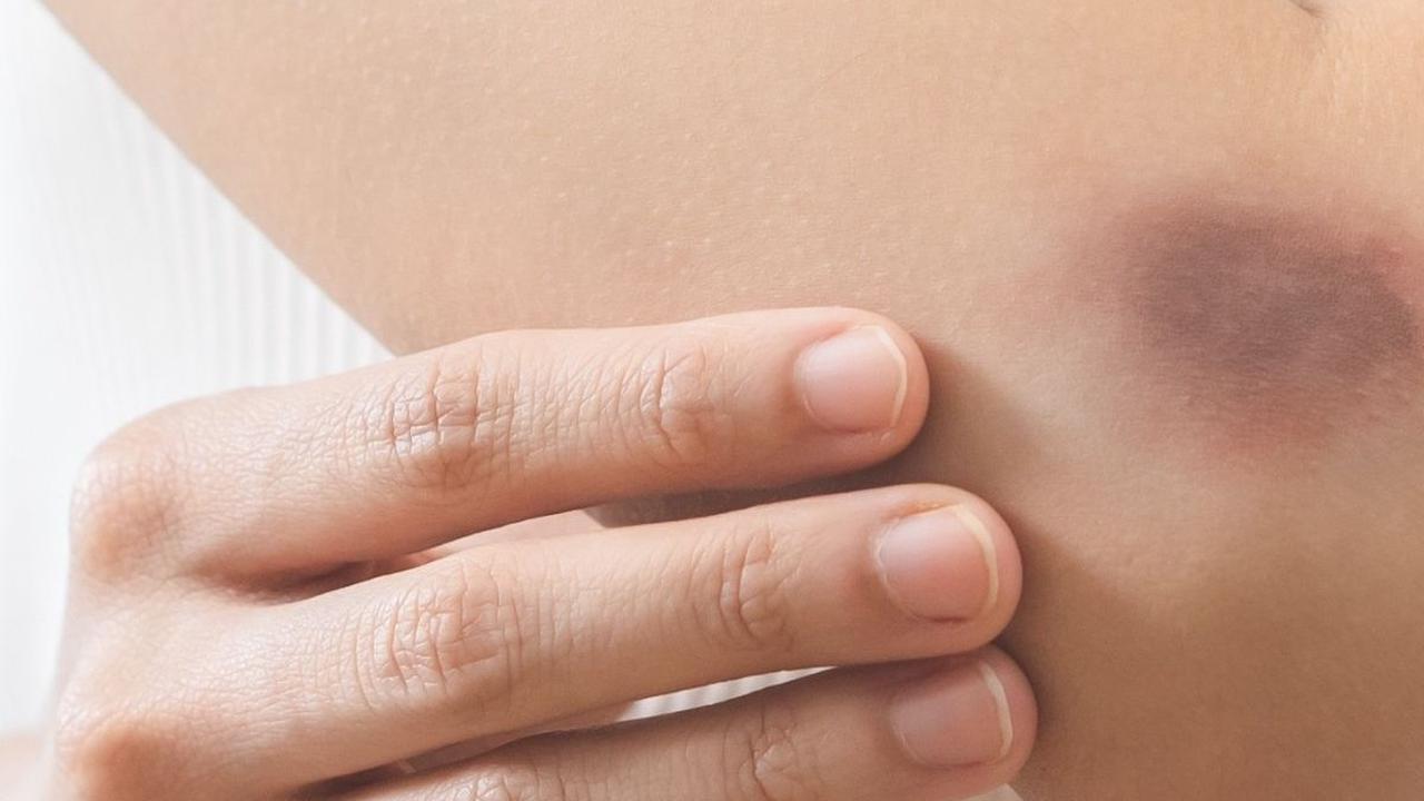 Tubuh Tiba-tiba Memar, Mungkin Kamu Kurang Vitamin Ini