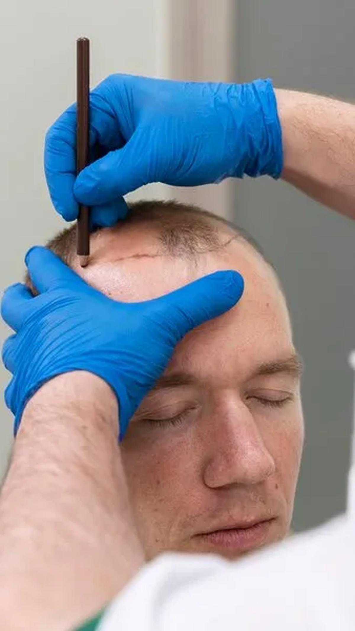 Stres Berat: Pengaruh Emosional pada Kesehatan Rambut