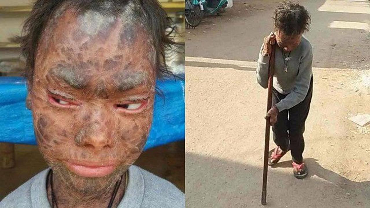 Alami Penyakit Langka, Penampilan Gadis Ini Bikin Warga Takut