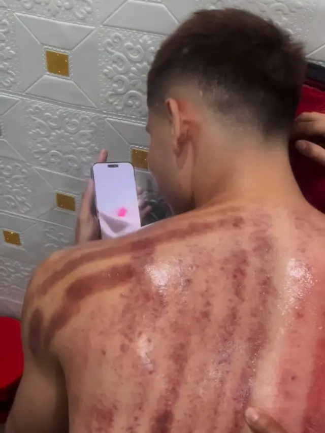 Potret Aisar Khaled setelah kerokan. (credit: instagram.com/aisar_khaledd)