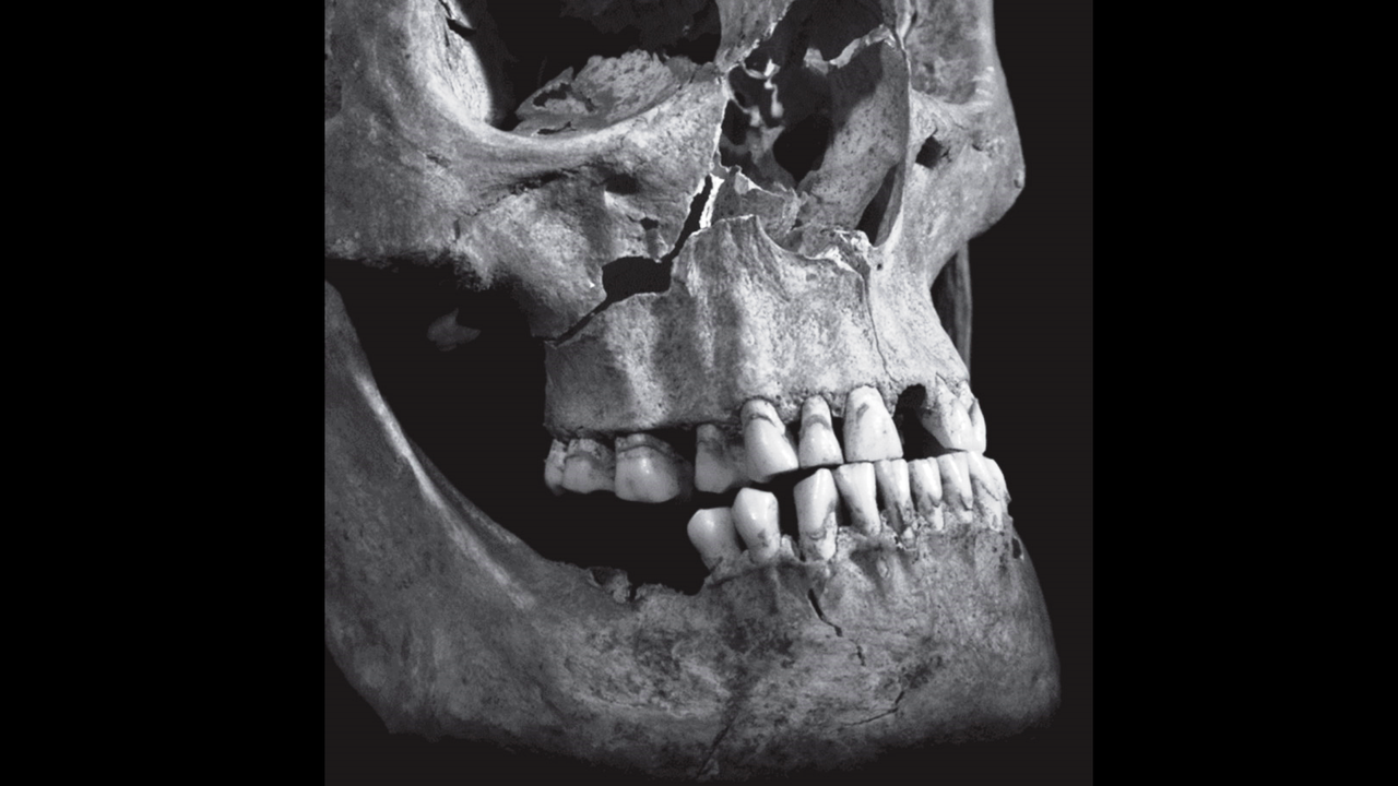 Cedera pada Kerangka Raja Inggris Richard III