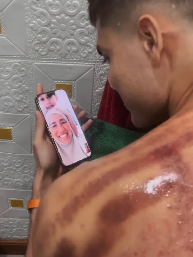 Potret Aisar Khaled setelah kerokan. (credit: instagram.com/aisar_khaledd)