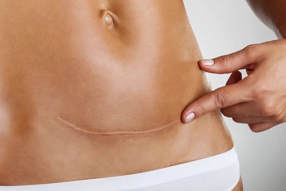 Pentingnya Jujur Miliki Bakat Keloid Saat Akan Melahirkan