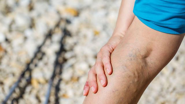 Cara Mencegah Munculnya Varises