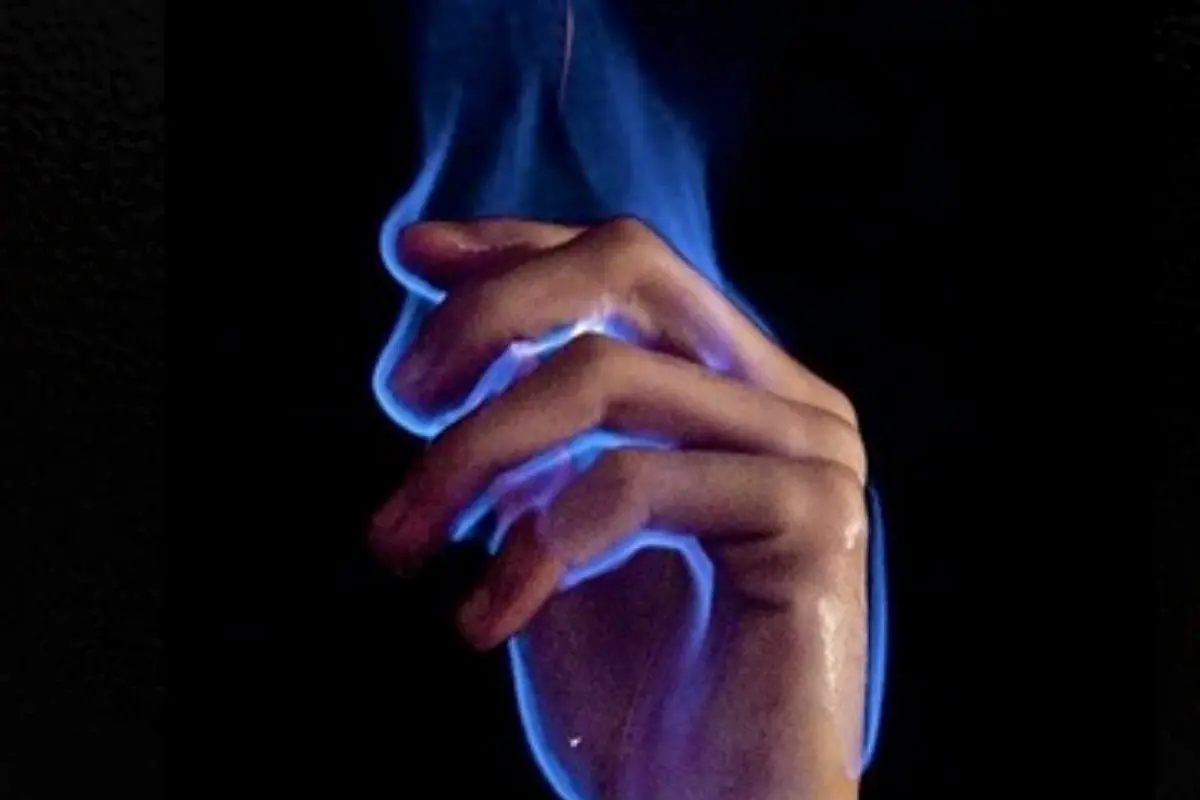 Luka bakar