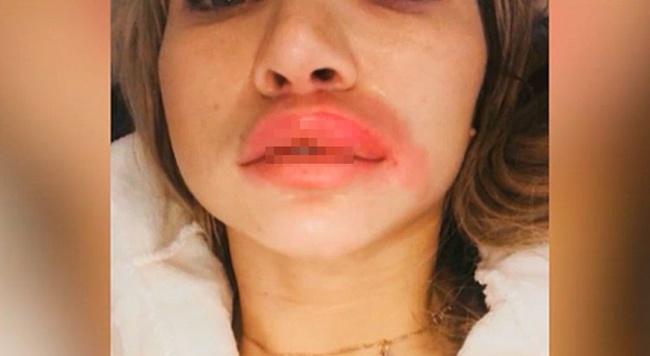 Bibir Eliza mengalami bengkak parah setelah mendapat suntikan cairan dari temannya bernama Irina/copyright odditycentral.com