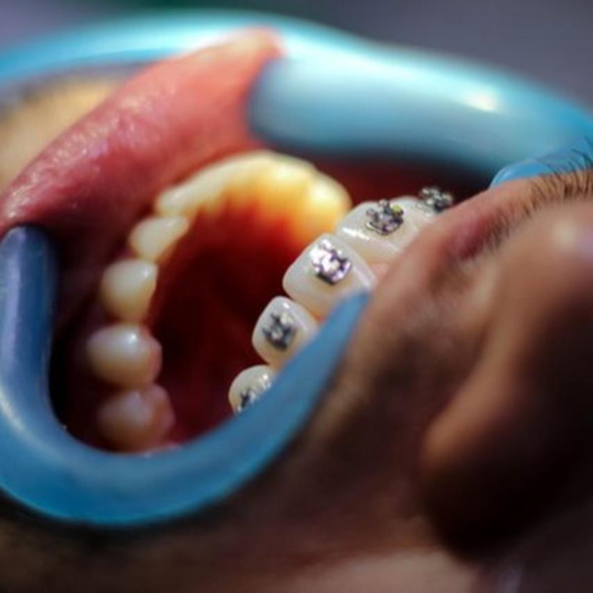 Manfaat Retainer Gigi dan Prosedur Pemasangannya, Perlu Diketahui
