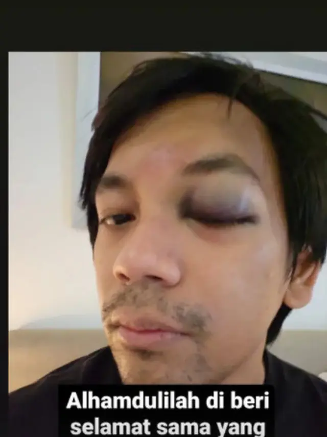 5 Potret Terkini Rian D'Masiv Usai Alami Kecelakaan, Mata Memar