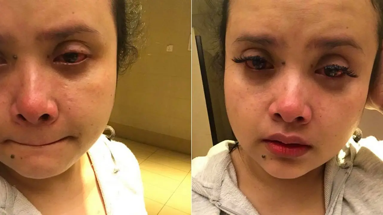 Niat Jadi Cantik, Wanita ini Malah Kehilangan Bulu Matanya