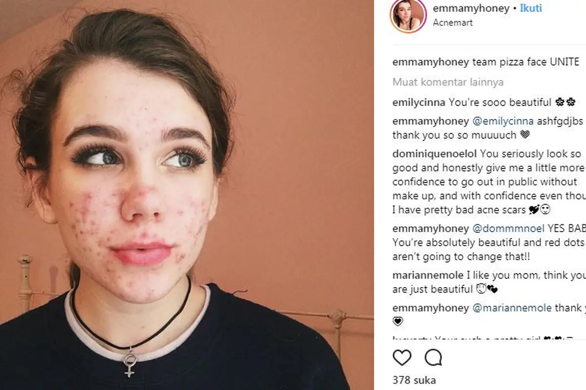 Emma berjuang atasi jerawat. (Foto: Instagram/emmamyhoney)
