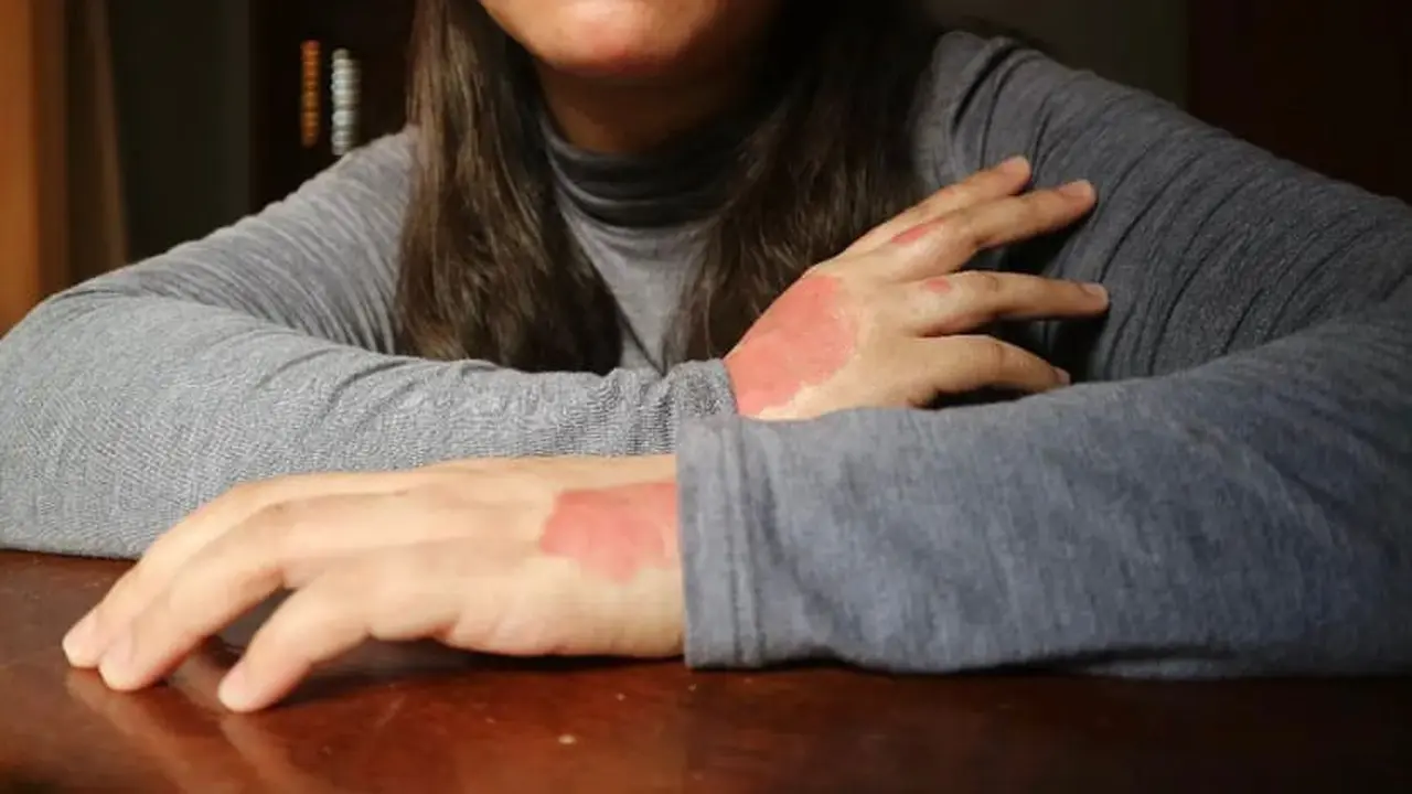 Psoriasis Vulgaris