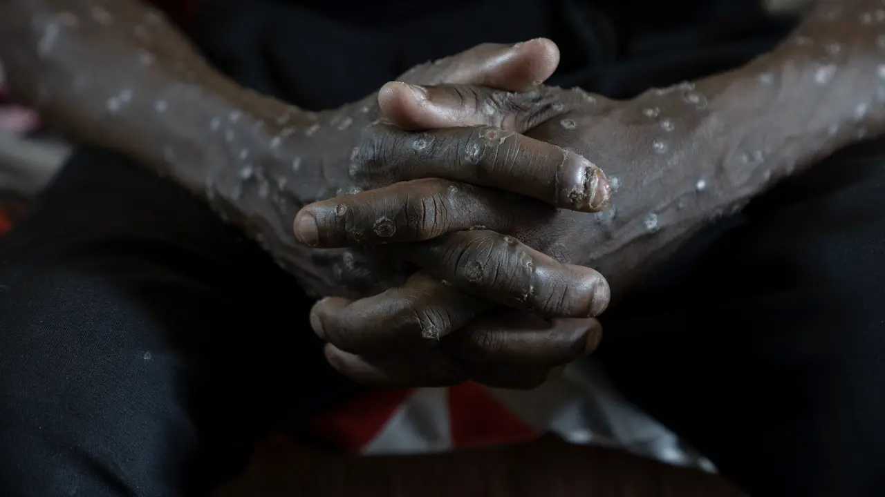 Mpox di Kongo