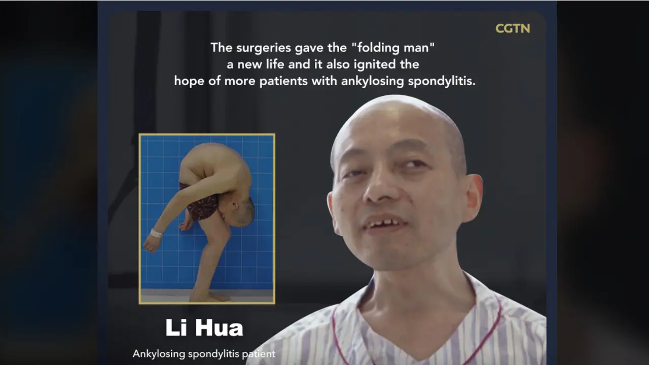 Li Hua, pria berlipat yang kini bisa berdiri tegak