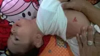 Tanda lahir di pinggang sebelah kanan bayi Gio. (Liputan6.com/Bangun Santoso)