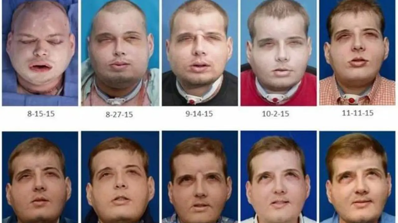 transplatasi