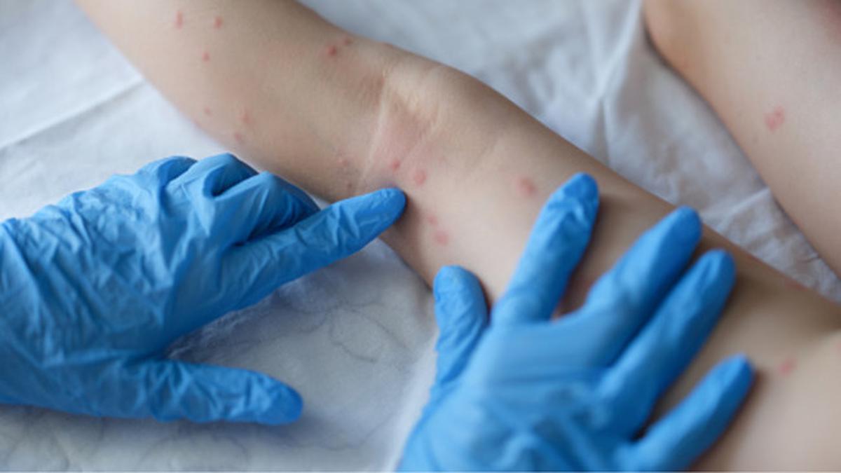 Fakta Mengejutkan Cacar Api pada Dewasa: Kenali Gejala dan Cara Mengatasinya