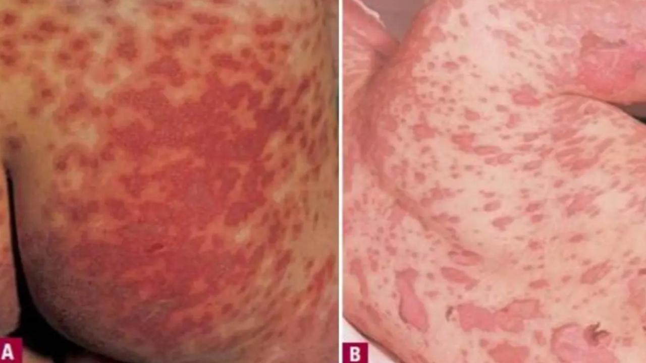 Steven Johnson Syndrome: Panduan untuk Pasien dan Keluarga dalam Proses Diagnosa